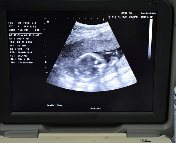 Monitor Portable Ultrasonography Showing Head Fetus Gestational Age Weeks Days — Stock Photo, Image