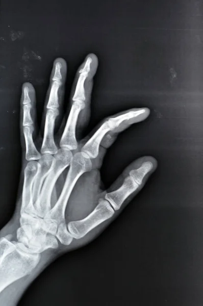Звичайний Рентгенівський Промінь Показує Основу Деформації Дистальної Фаланги Лівого Середнього — стокове фото