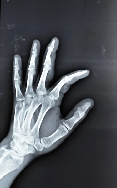 Звичайний Рентгенівський Промінь Показує Основу Деформації Дистальної Фаланги Лівого Середнього — стокове фото