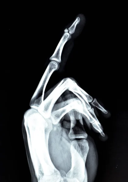 Złamanie Przemieszczenie Małego Kawałka Kości Podstawy Dystalnej Paliczka Lewego Środkowego — Zdjęcie stockowe