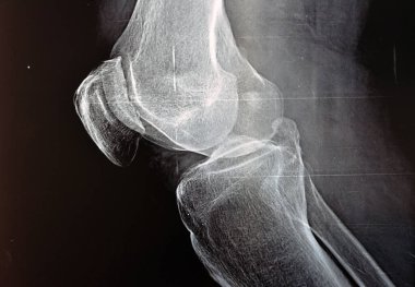 Sağ dizin röntgeni, kemik erimesini sınıflandırmak ve uzayı daraltmak için Kellgren ve Lawrence sistemine göre eklem iltihabı olduğunu gösteriyor. 