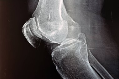 Sağ dizin röntgeni, kemik erimesini sınıflandırmak ve uzayı daraltmak için Kellgren ve Lawrence sistemine göre eklem iltihabı olduğunu gösteriyor. 