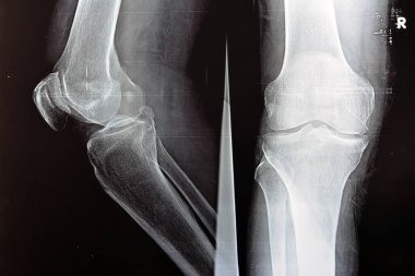 Sağ dizin röntgeni, kemik erimesini sınıflandırmak ve uzayı daraltmak için Kellgren ve Lawrence sistemine göre eklem iltihabı olduğunu gösteriyor. 