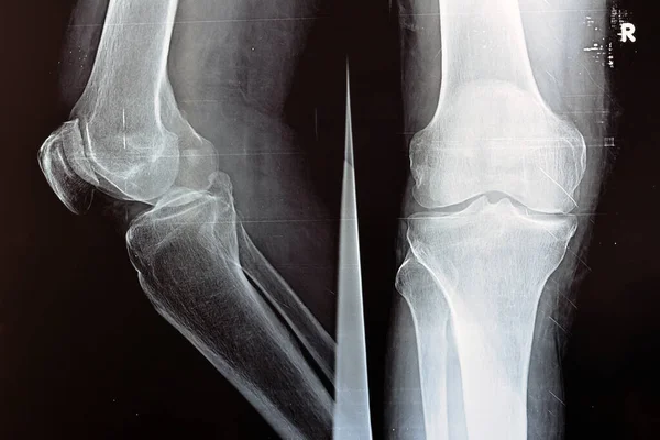 Plain Ray Right Knee Shows Apparent Joint Osteoarthritis According Kellgren — Stock Photo, Image