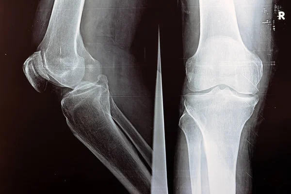 Plain Ray Right Knee Shows Apparent Joint Osteoarthritis According Kellgren — Stock Photo, Image