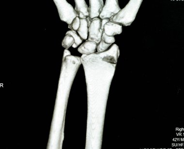 Tomografi sağ bilek eklem görüntüsü kapalı indirgeme ve döküm için sağ distal yarıçap kırığı gösteriyor. CAT taramasının seçici odağı bilek travmasından sonra kırık yarıçapı kemiğini gösteriyor.