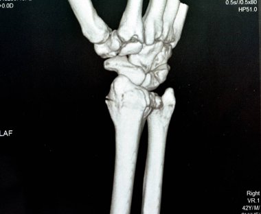 Tomografi sağ bilek eklem görüntüsü kapalı indirgeme ve döküm için sağ distal yarıçap kırığı gösteriyor. CAT taramasının seçici odağı bilek travmasından sonra kırık yarıçapı kemiğini gösteriyor.