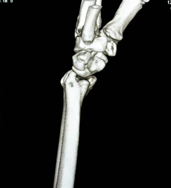 CT scan right wrist joint 3D view shows right distal radius fracture for closed reduction and cast, selective focus of a CAT scan imaging showing fracture radius bone after direct trauma to the wrist