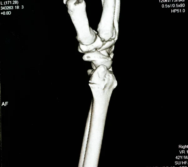 Ct扫描右腕关节3D图像显示右远端桡骨骨折为闭合性复位和铸造 Cat扫描图像显示腕部直接外伤后骨折半径骨的选择焦点 — 图库照片