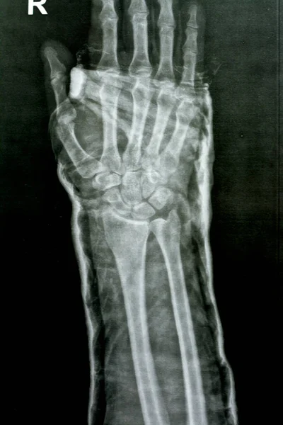 Plain x ray right wrist joint shows right distal radius fracture, closed reduction and cast done, selective focus of x-ray imaging showing fracture radius bone after direct trauma to the wrist