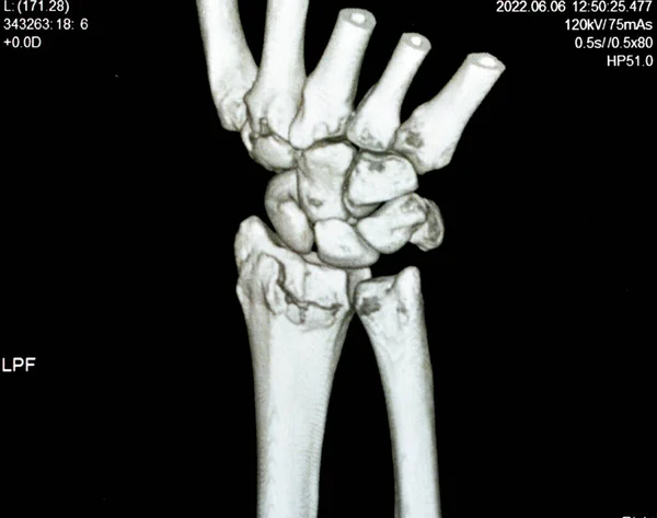 CT scan right wrist joint 3D view shows right distal radius fracture for closed reduction and cast, selective focus of a CAT scan imaging showing fracture radius bone after direct trauma to the wrist