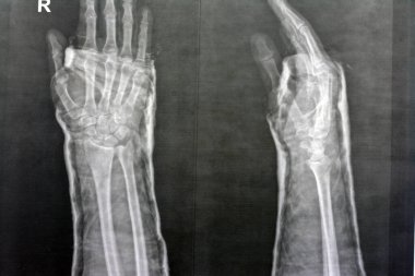 Düz x ışını sağ bilek eklemi sağ distal yarıçap kırığı, kapalı küçültme ve alçı, X-ray görüntülemesinin seçici odağı bilek travmasından sonra kırığın yarıçapı kemiğini gösteriyor.