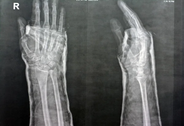 Plain x ray right wrist joint shows right distal radius fracture, closed reduction and cast done, selective focus of x-ray imaging showing fracture radius bone after direct trauma to the wrist