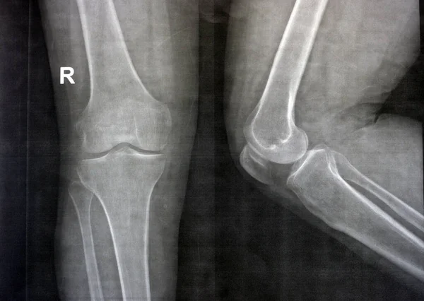 Radiografia Simples Joelho Direito Mostra Osteoartrite Articular Aparente Acordo Com — Fotografia de Stock