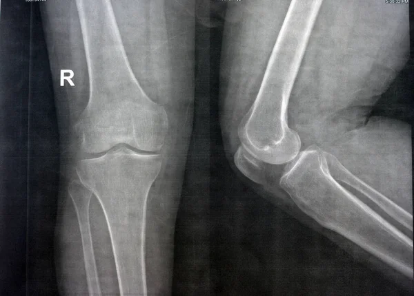 Einfaches Röntgenbild Des Rechten Knies Zeigt Offensichtliche Gelenkarthrose Nach Kellgren — Stockfoto
