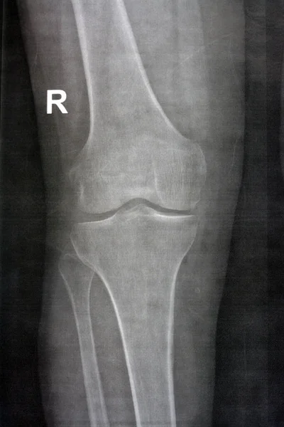 Radiografía Simple Rodilla Derecha Muestra Osteoartritis Articular Aparente Acuerdo Con — Foto de Stock