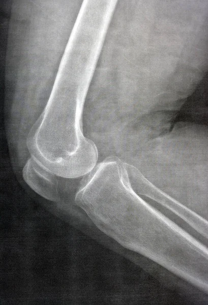 Radiografía Simple Rodilla Derecha Muestra Osteoartritis Articular Aparente Acuerdo Con —  Fotos de Stock