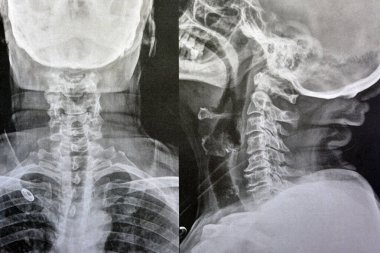 Plain X ray cervical vertebrae showing straightening of cervical vertebrae denoting muscle spasm and mild to moderate spondylosis from c3 3rd cervical vertebra to c6 6th cervical vertebra