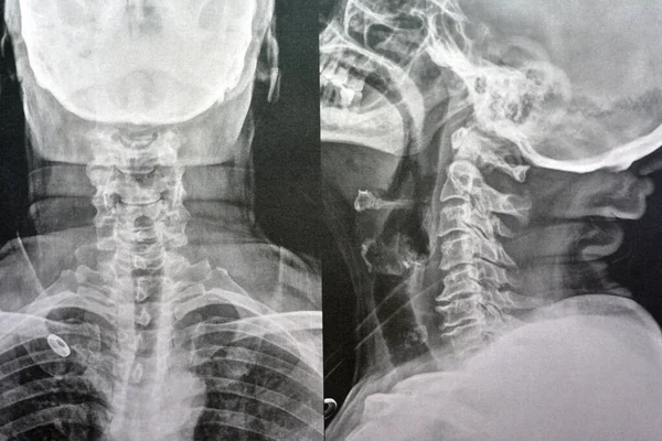 Plain X ray cervical vertebrae showing straightening of cervical vertebrae denoting muscle spasm and mild to moderate spondylosis from c3 3rd cervical vertebra to c6 6th cervical vertebra