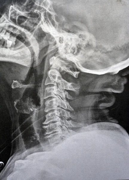 Plain X ray cervical vertebrae showing straightening of cervical vertebrae denoting muscle spasm and mild to moderate spondylosis from c3 3rd cervical vertebra to c6 6th cervical vertebra