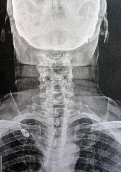 Plain X ray cervical vertebrae showing straightening of cervical vertebrae denoting muscle spasm and mild to moderate spondylosis from c3 3rd cervical vertebra to c6 6th cervical vertebra