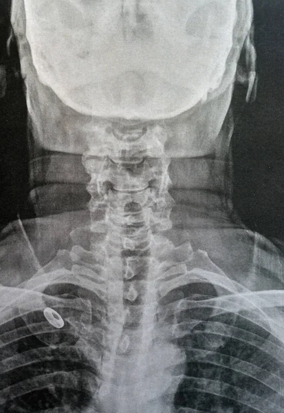 Plain X ray cervical vertebrae showing straightening of cervical vertebrae denoting muscle spasm and mild to moderate spondylosis from c3 3rd cervical vertebra to c6 6th cervical vertebra