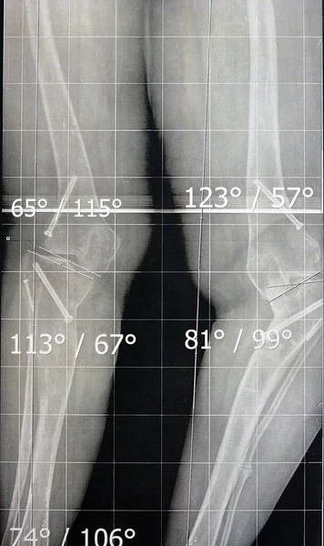 Проста Позиція Рентгенівської Плівки Показує Обидві Ноги Двостороннім Метафізичним Рівнем — стокове фото