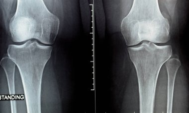 Diz eklemi üzerindeki düz x ışını eklem boşluğunun daraldığını gösteriyor ve orta bölümde subkondral skleroz (osteoartritten etkilenen eklemlerde olan kemik kalınlaşması), diz osteoartriti