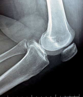 Diz eklemi üzerindeki düz x ışını eklem boşluğunun daraldığını gösteriyor ve orta bölümde subkondral skleroz (osteoartritten etkilenen eklemlerde olan kemik kalınlaşması), diz osteoartriti