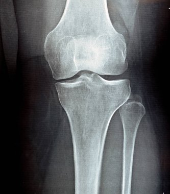 Diz eklemi üzerindeki düz x ışını eklem boşluğunun daraldığını gösteriyor ve orta bölümde subkondral skleroz (osteoartritten etkilenen eklemlerde olan kemik kalınlaşması), diz osteoartriti