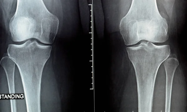 Plain Ray Knee Joint Showing Joint Space Narrowing Subchondral Sclerosis — Stock Photo, Image