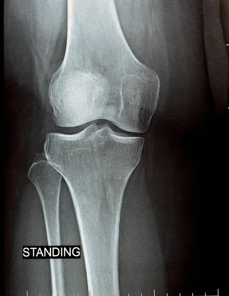 plain x ray on knee joint showing joint space narrowing and Subchondral Sclerosis on medial compartment (thickening of bone that happens in joints affected by osteoarthritis), knee osteoarthritis