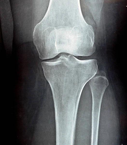 plain x ray on knee joint showing joint space narrowing and Subchondral Sclerosis on medial compartment (thickening of bone that happens in joints affected by osteoarthritis), knee osteoarthritis
