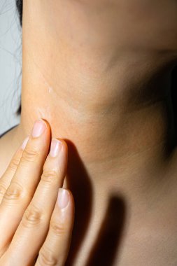 Bir kadının boynunda kızıl deri hastalığı