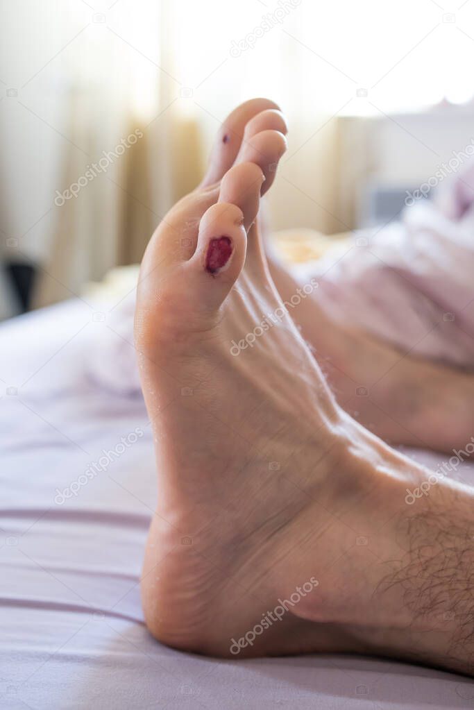 Men feet, small toe wound after plantar wart electrocautery surgery. 2023