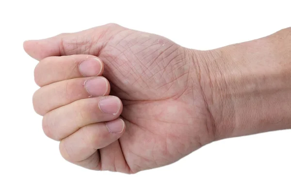 Senior Man Fingers Nails Dry Skin Cracked Skin Cuticles Skin — Stock Photo, Image