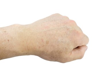 Age spots on hands of man. Liver spots, Brown, black or sun spots, Senile lentigo, Solar lentigines. Premature aging skin, Dermatology, Symptomatology Elderly Person. Isolated on white background. clipart