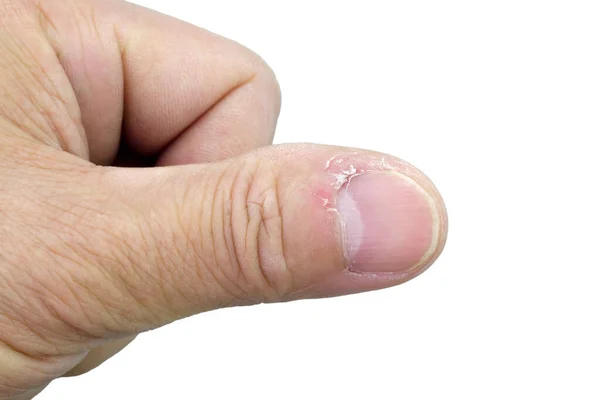 Close Thumb Nail Dry Skin Torn Flaking Cracked Skin Cuticles — 스톡 사진