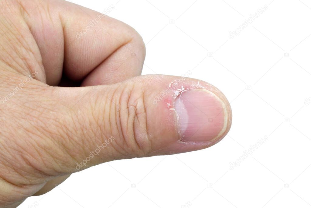 Painful nail with longitudinal erythronychia | MDedge Family Medicine