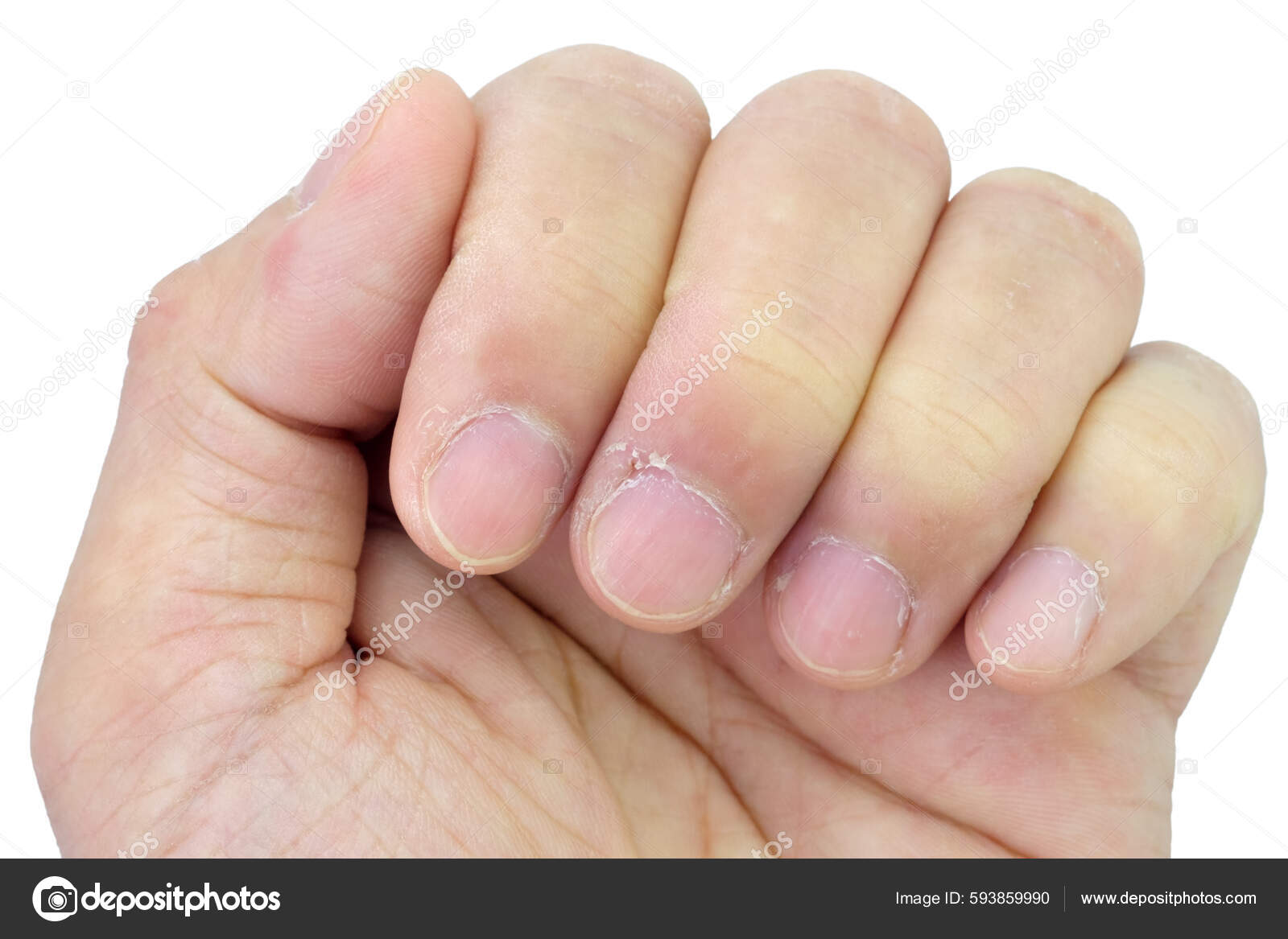 Closeup Of Thumb And Nail With Dry Skin Torn And Flaking Off Cracked Skin  On Cuticles Dry Brittle Nails Broken Fingernails Inflammation Chipped Nails  Isolated On White Background Stock Photo - Download