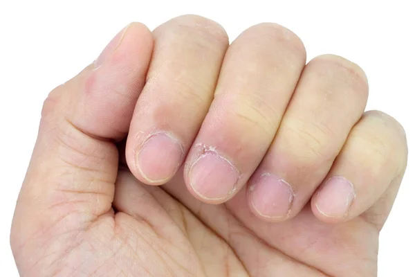 Close Fingers Nails Dry Skin Torn Flaking Cracked Skin Cuticles — Zdjęcie stockowe