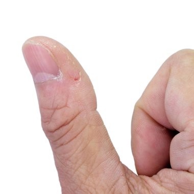Close-up of thumb and nail with dry skin, torn and flaking off, cracked skin on cuticles, dry brittle nails. Broken fingernails inflammation. Chipped nails. Isolated on white background.