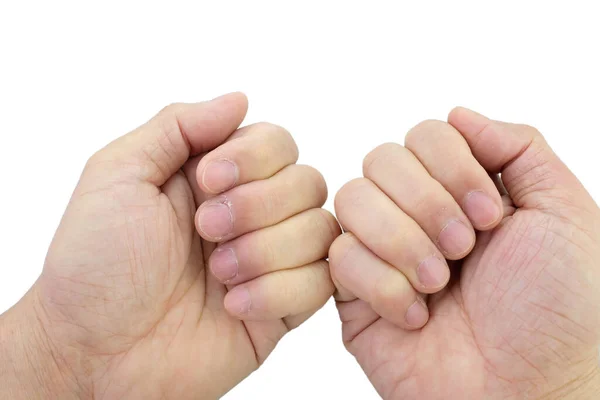 Close Fingers Nails Dry Skin Torn Flaking Cracked Skin Cuticles — Zdjęcie stockowe