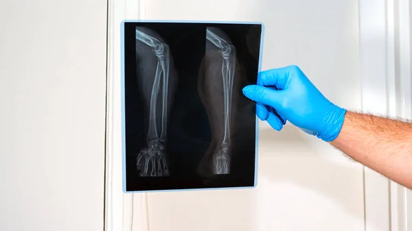 Sağ Kol Röntgeni Yaralanması Doktor Kol Yaralanması Kol Kası Yaralanması — Stok fotoğraf