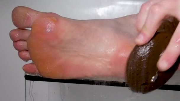 Nahaufnahme Peeling Und Rissiger Fuß Bei Einer Person Pilzinfektion Oder — Stockvideo