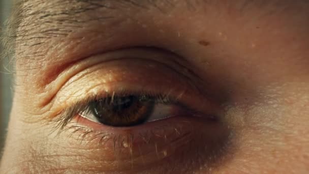 Macro tiro de olho de homem com fibroma. Fibroma na pele dos homens. Cuidados com a pele fibroma. — Vídeo de Stock