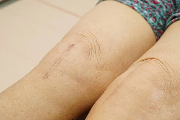 Asiatique Femme Âgée Patient Avec Cicatrice Genou Chirurgie Remplacement Hôpital — Photo