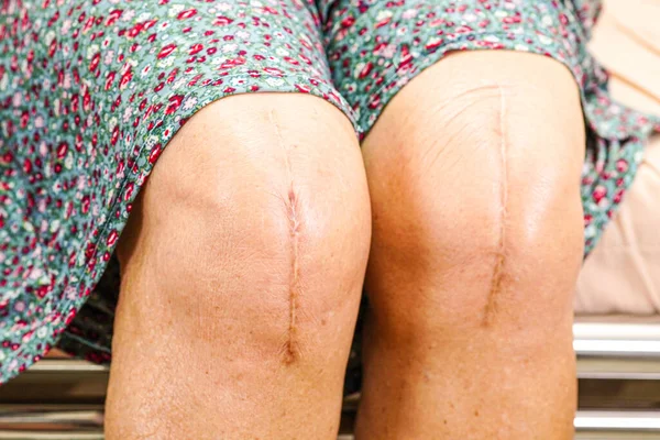 Asiatique Femme Âgée Patient Avec Cicatrice Genou Chirurgie Remplacement Hôpital — Photo