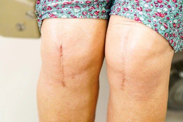 Asiática Anciana Paciente Con Cicatriz Cirugía Reemplazo Rodilla Hospital — Foto de Stock