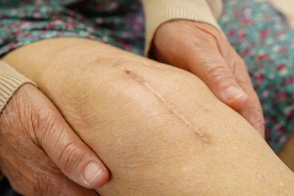 亚洲老年妇女在医院接受疤痕膝关节置换手术 — 图库照片
